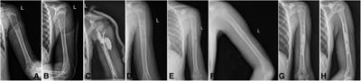 Percutaneous calcium sulfate injection versus localized scrape bone grafting: clinical effect comparison in titanium elastic nail treatment of pathological fracture of proximal humerus caused by unicameral bone cysts in children